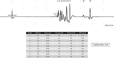 Muscle fiber conduction velocity in situ revisited: A new approach to an ancient technique